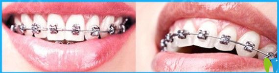 廣州壹加壹口腔金屬托槽牙齒矯正圖