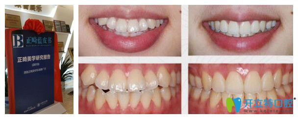 好佰年口腔正畸藍(lán)皮書和案例