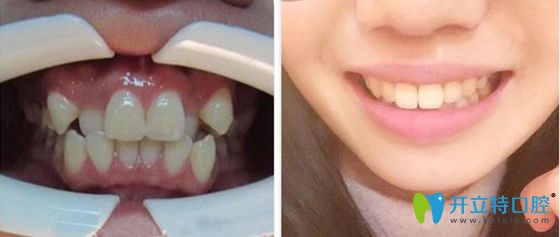東莞壹加壹口腔牙齒矯正案例效果圖 東莞壹加壹口腔牙齒矯正案例效果圖