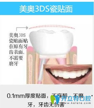杭州美奧口腔3DS瓷貼面修復(fù)