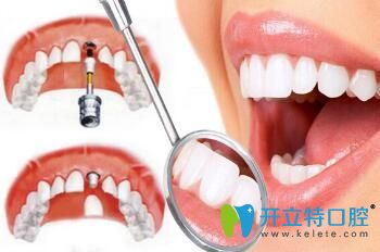 昆明尚愛韓美口腔陸成華介紹種植牙術(shù)后注意事項