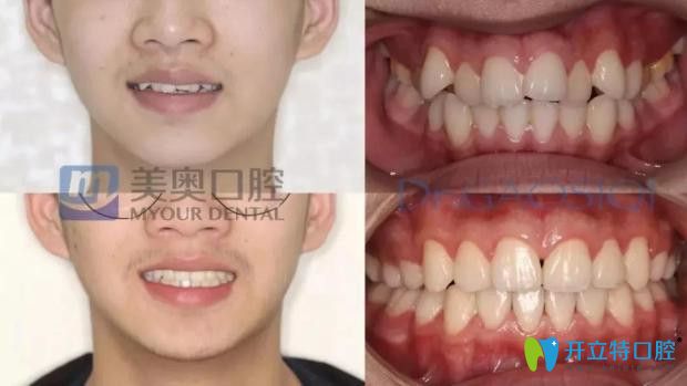 杭州美奧口腔虎牙矯正案例