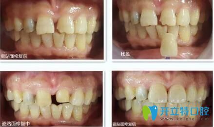 瑾帆口腔牙齒瓷貼面修復(fù)案例