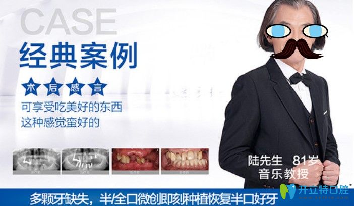 杭州美奧口腔半口即刻種植牙案例