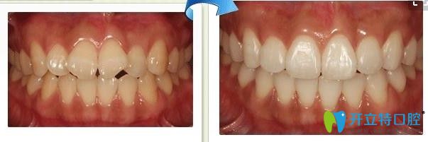 廣州圣貝口腔牙列歪斜矯正