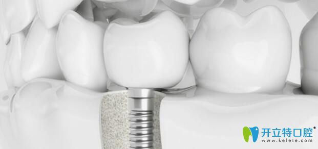 老爸在南昌輝煌口腔做ALL-ON-4/6全口種植牙當(dāng)天就能吃東西啦