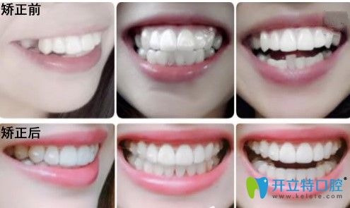 廣州圣貝口腔牙齒不齊矯正