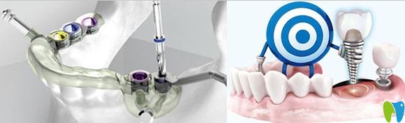 3d導(dǎo)板種植牙詳情介紹