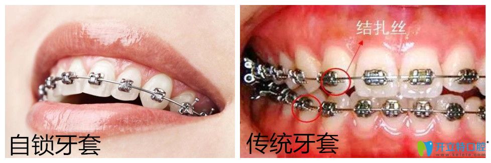 自鎖托槽牙齒矯正多少錢？正畸國(guó)產(chǎn)與進(jìn)口自鎖有區(qū)別嗎?
