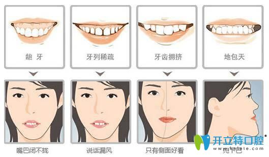 昆明尚愛韓美口腔孔明星提醒牙齒矯正要盡早