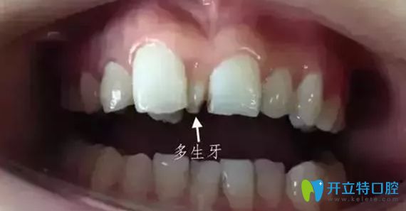 埋伏牙與多生牙區(qū)別圖
