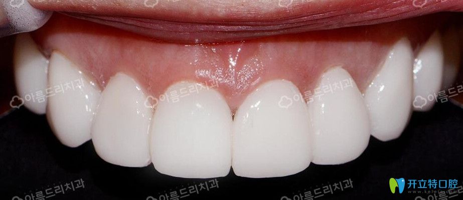韓國安特麗牙貼面后效果圖