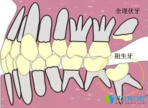什么是埋伏牙阻生牙示意圖