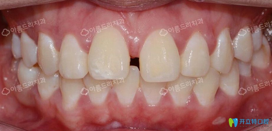 韓國(guó)牙科水平怎么樣?安特麗牙科種植矯正案例及評(píng)價(jià)供參考