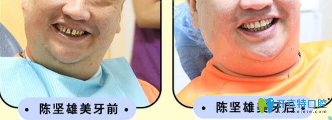 陳先生采用瓷貼面修復(fù)發(fā)黃牙齒案例