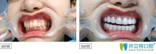 曙光口腔平面模特矯正牙齒案例