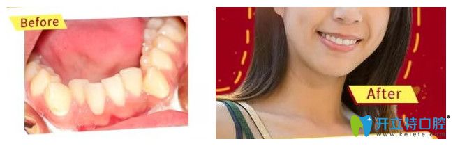 22歲經(jīng)理助理在柏德口腔矯正牙齒案例