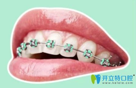 圣貝口腔炫彩金屬牙套