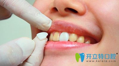南昌輝煌口腔胡瑞雪科普牙齒貼面后注意事項(xiàng)