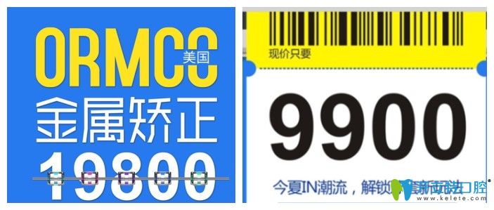 成都圣貝口腔美國(guó)奧美科金屬矯正價(jià)格