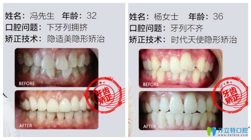 德韓口腔牙齒矯正案例前后效果對(duì)比圖