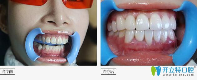 在校<!--<i data=20240703-sp></i>-->生選擇曙光醫(yī)院矯正牙齒案例