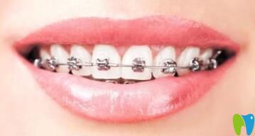 南昌輝煌口腔劉梅分享自鎖托槽牙齒矯正優(yōu)勢(shì)