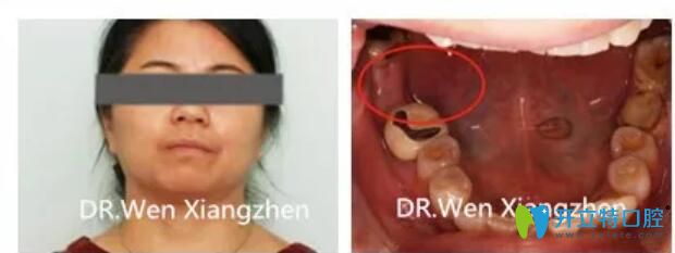 震驚！林阿姨在湖州鼎植口腔做了一顆種植牙價(jià)格才2500元