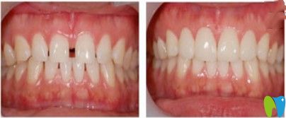 諾德口腔牙縫過大矯正案例圖