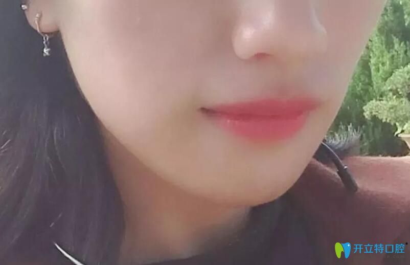 戴牙套過程掛橡皮筋收縫階段正面臉型圖