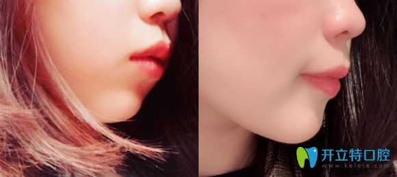 西安中諾口腔牙齒矯正側貌前后對比效果圖