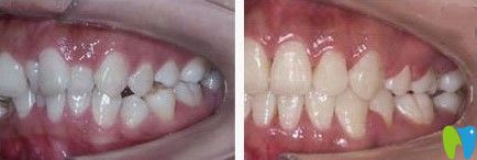 諾德齒科牙齒擁擠不齊矯正案例圖