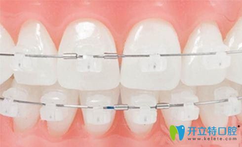 陶瓷托槽15000貴嗎?詳解半隱形陶瓷托槽牙齒矯正價(jià)格多少錢(qián)?