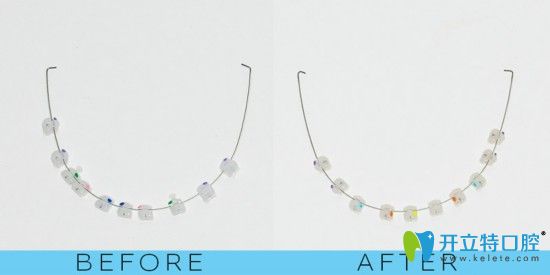 我在廣州柏德口腔戴的半隱形陶瓷牙套