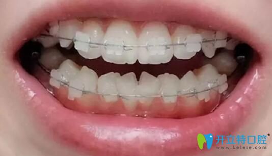 我在廣州柏德口腔做牙齒矯正第6個月