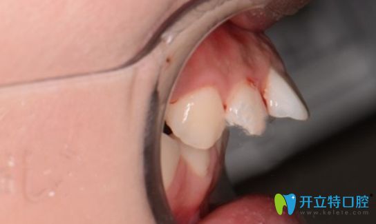 新鄉(xiāng)拜博口腔牙齒正畸術前側面照