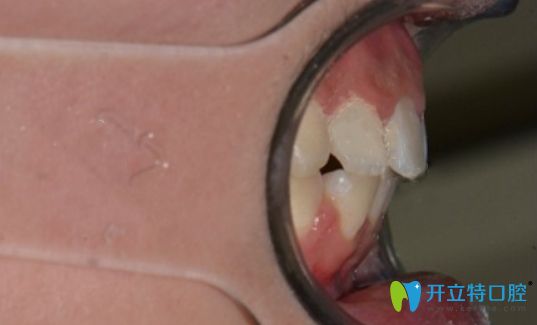 在新鄉(xiāng)拜博口腔做金屬自鎖托槽正畸術后側面照