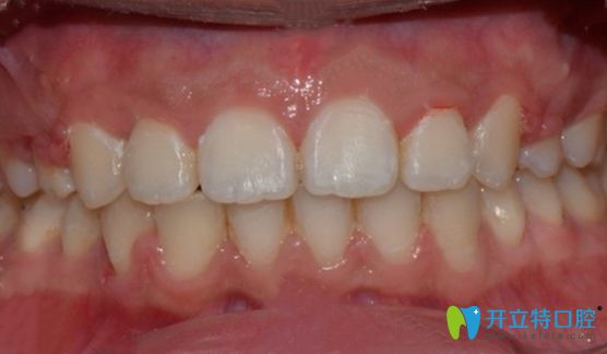 新鄉(xiāng)拜博口腔牙齒矯正術后正面照