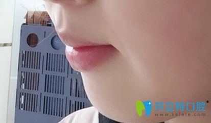 中信惠州口腔做完牙齒矯正的側(cè)面照