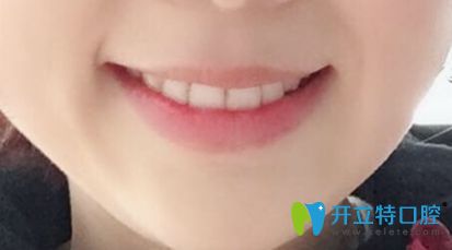 在中信惠州醫(yī)院牙科做完牙齒正畸后的樣子