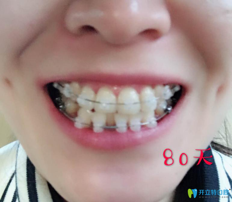 在西安中諾口腔做牙齒矯正第80天