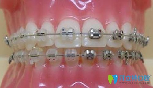 惠州中信口腔鋼絲牙套展示圖