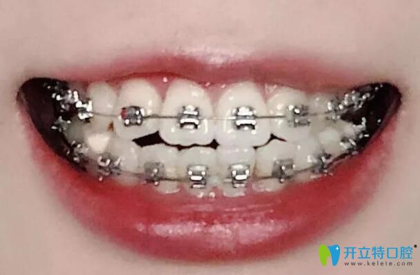 我在珠海仁愛口腔戴金屬牙套第12個月