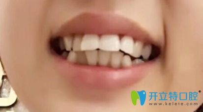 26歲在中信惠州醫(yī)院口腔科開(kāi)啟了牙齒矯正之旅,現(xiàn)下牙套啦!