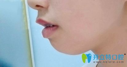 選擇在中信惠州醫(yī)院戴金屬自鎖托槽牙套矯正牙齒