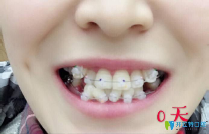 西安中諾口腔靠譜嗎?我做半隱形陶瓷牙齒矯正后來評價(jià)啦