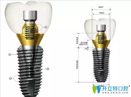 韓國登騰種植體解剖圖