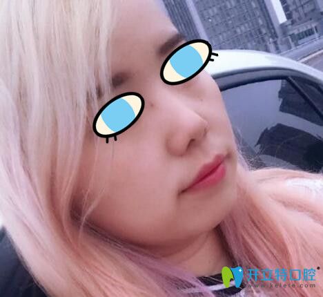 我在鄭州拜博口腔做牙齒矯正1年