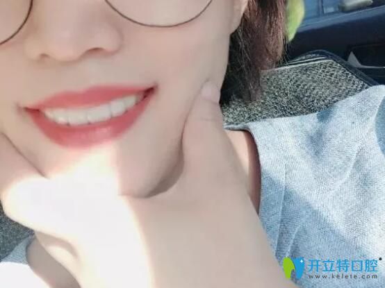 拜博口腔牙齒矯正2年后下牙套戴保持器樣子