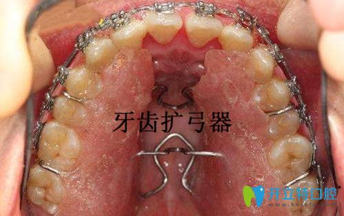 本想擴(kuò)弓改變嘴凸,有人說牙齒擴(kuò)弓后會(huì)更凸,真的嗎